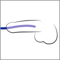 Silicone Dilator Set